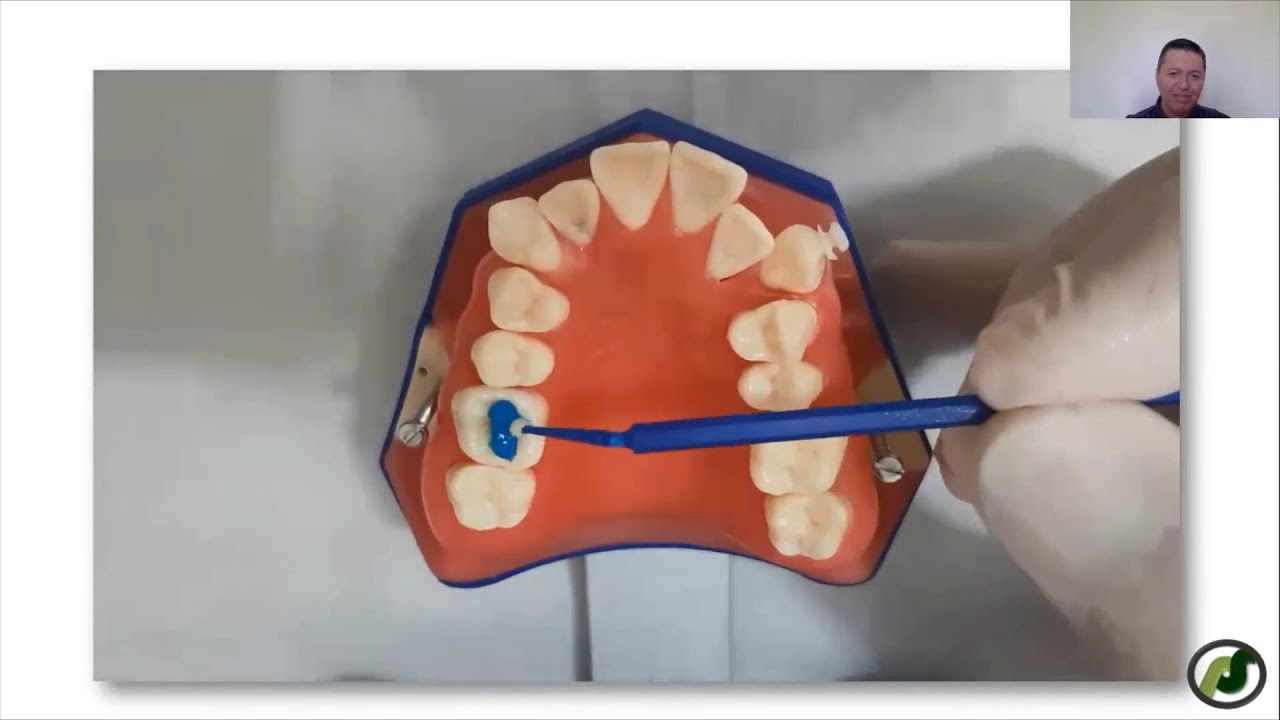 Levante de mordida posterior  - Ortodontia