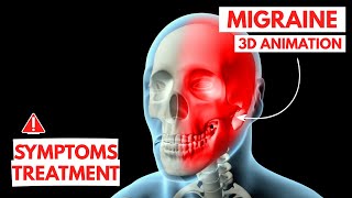 Understanding Migraines: Triggers, Symptoms, and Treatment Options | 3D Animation
