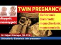 Twin pregnancy types(dichorionic-diamniotic),(monochorionic-diamniotic),monoamniotic,mono/di-zygotic