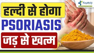 क्या हल्दी से सोरायसिस खत्म हो सकता है? Can turmeric treat psoriasis? #Psoriasis treatment at Home