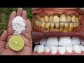 सिर्फ 3 मिनट में गंदे पीले दाँतो को मोतियों जैसा सफेद चमकदार बना देगा | teeth whitening | dant safed