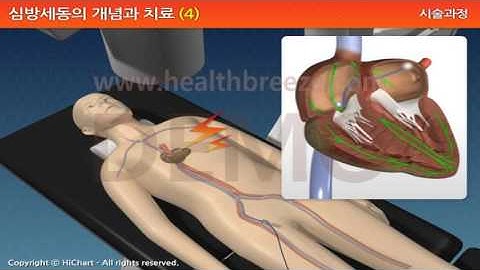 [시연용] a0102adko 심방세동의 개념과 치료 4 전극도자절제술