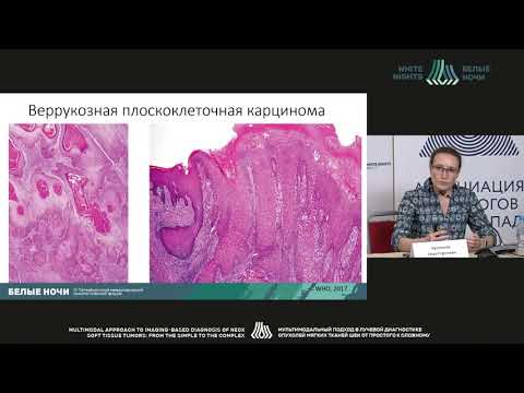 Морфологические аспекты опухолей ротовой полости, носоглотки, гортани (Артемьева А.С.)