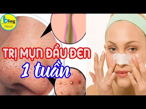 Cách trị mụn đầu đen ở mũi hiệu quả trong 1 tuần