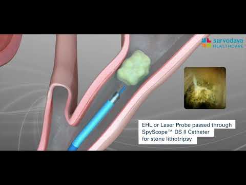 Spyglass Cholangioscopy Machine | Dr. Bir Singh Sherawat
