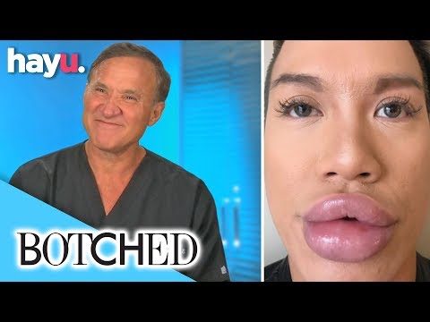 Video: Woman's Lips Look Like Giant Beans After Failed Filler Injections