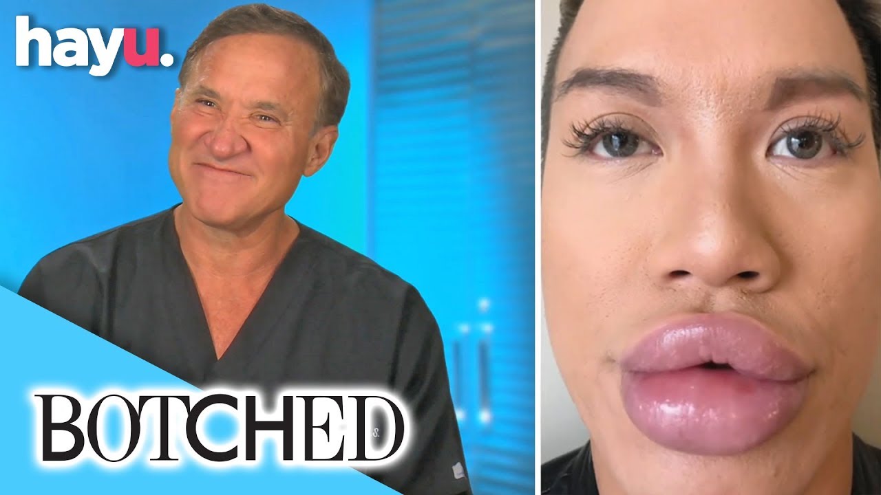 Guy With Big Lips On Botched