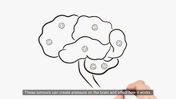 Learning more about brain metastases in breast cancer