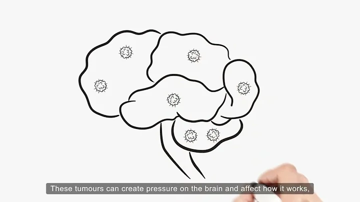 Learning more about brain metastases in breast cancer