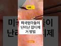 미국엄마들이 난리난 잡티제거법