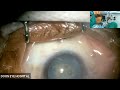 Live cataract surgery by dr rajendra prasad uttara eyecon 2022 at doon hospital