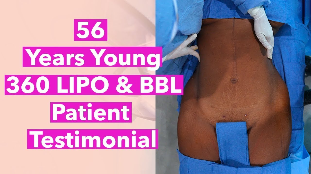 56 Years Young 360 Liposuction with Brazilian Butt Lift(BBL), Weight ...
