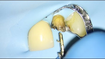 How to remove a dental cast post - full step-by-step guide | I ❤️ the pulp