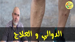 مرض الدوالي الأسباب و العلاج بطرق طبيعية فعالة  -  الدكتور كريم العابد العلوي -