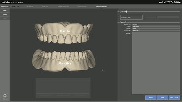 14 Denture replication configuration