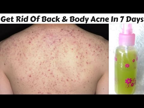 How To Get Rid Of Back And Body Acne In Just  Days | DIY Back and Body Acne Spray