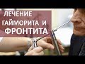 Гайморит кукушка. 👃 Лечение гайморита методом кукушки. МОСИТАЛМЕД.