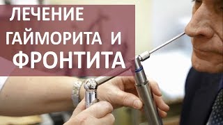 Гайморит кукушка. 👃 Лечение гайморита методом кукушки. МОСИТАЛМЕД.