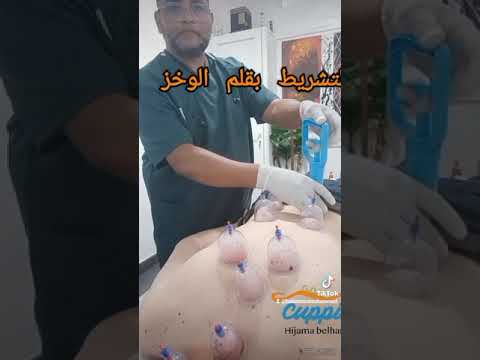 طريقة التشريط بقلم الوخز حجامة منظبطة ذ محمد بلهنتوت الحسيني 0668199203 تمارة مركز نور الزهراء