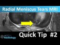 MSK Quick tip #2 - Simple way to see radial meniscus tears