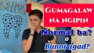 PERIODONTITIS: Gumagalaw na ngipin?