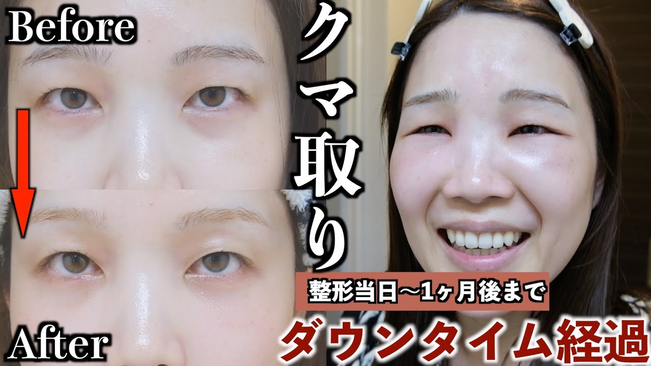 【整形レポ】くま取りのリアル全部見せます。ダウンタイム1ヶ月の記録と変化🧸