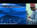Laparoscopic hepaticojejunostomy / Лапароскопическая гепатикоеюностомия LIVE