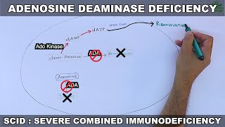 Adenosine Deaminase Deficiency | SCID