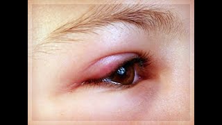 Опух глаз (ячмень) у ребенка 5 лет и взрослого Чем лечить  - ЛАЙФХАК от тети Сони