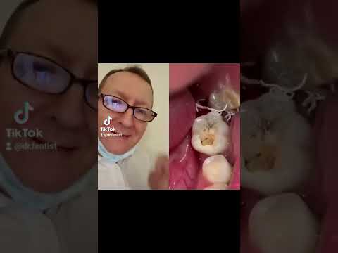 Когда не выдержала эмаль! #shorts #рот #fentist#стоматолог #doctor