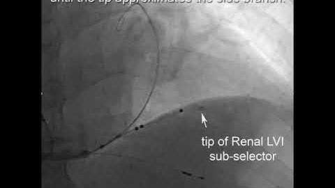 Video 8 Vein Selector Venogram to indentify side branch for an alternative target sitewith permissio