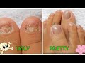 Polygel Toenails W/ Dual Forms On Toes With No Nails / Beginner Detailed Step By Step
