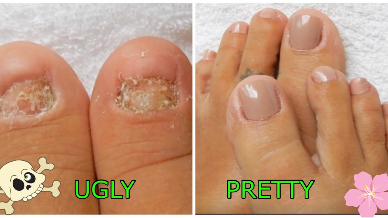 Is it bad to put SNS to make a fake nail over a lost toenail? - Quora