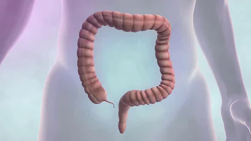 C'est quoi un polype dans l'intestin ?
