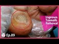 TOP MEDICAL PEDICURE Ep.89 - Ingrown Toenails Should Be Removed Like This