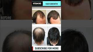 Top 5 Best Hair Growth Vitamins 2023 |  #hairgrowth  #hairfall #haircare