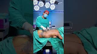 Parte 1: Mommy Makeover posterior ( Lipotransferencia + RIBXCAR)