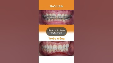 Hành trình LỘT XÁC nhờ niềng răng của Khánh Ngân