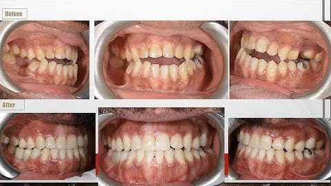 Class III malocclusion , non growing adult patient and anterior open bite