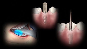 Restorative Intraoral Scan Process Flow with Rosetta Scan Body using Sirona Cerec system