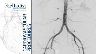 External Iliac Artery Balloon Angioplasty And Stenting (Alan B. Lumsden, MD, M. Mujeeb Zubair, MD) External Iliac Artery Balloon Angioplasty And Stenting (Alan B. Lumsden, MD, M. Mujeeb Zubair, MD)