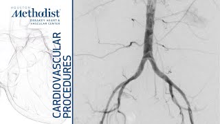 External Iliac Artery Balloon Angioplasty and Stenting (Alan B. Lumsden, MD, M. Mujeeb Zubair, MD) screenshot 3