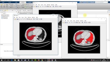 Region Growing. Segmentation by growing a region from seed point in Matlab