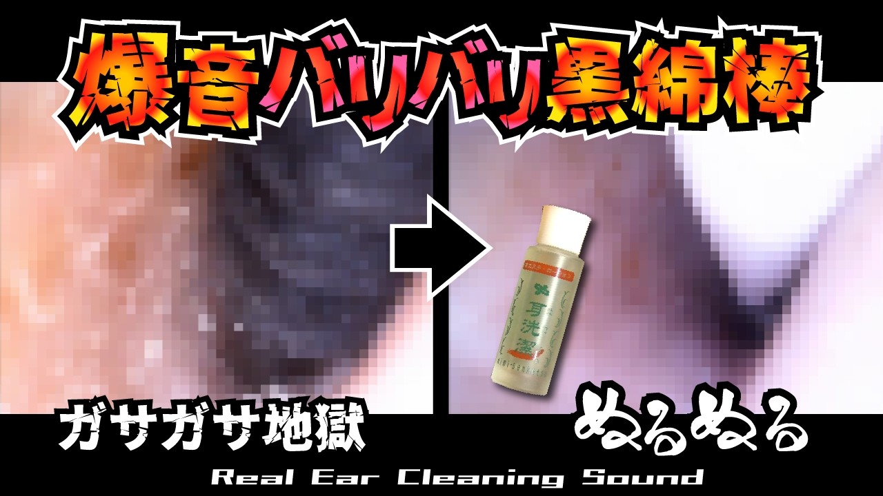 【耳の奥で爆音バリバリ！】ガサガサ地獄が超絶ヌルヌルになる瞬間/黒綿棒×トンガリ綿棒×耳洗潔/削除動画復活/爆裂イヤースコープ耳掃除/引掻き音/マッサージ/痒み解消/睡眠導入【本物耳かきASMR】