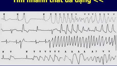 Xử trí cấp cứu rối loạn nhịp