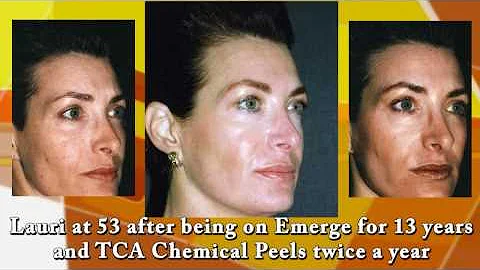 Live Chemical Peel on Lauri Kane, wife of Dr. Dean Kane