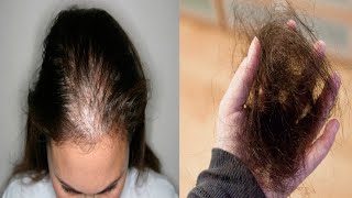 Выпадение волос после вируса Короны | Как остановить выпадение волос