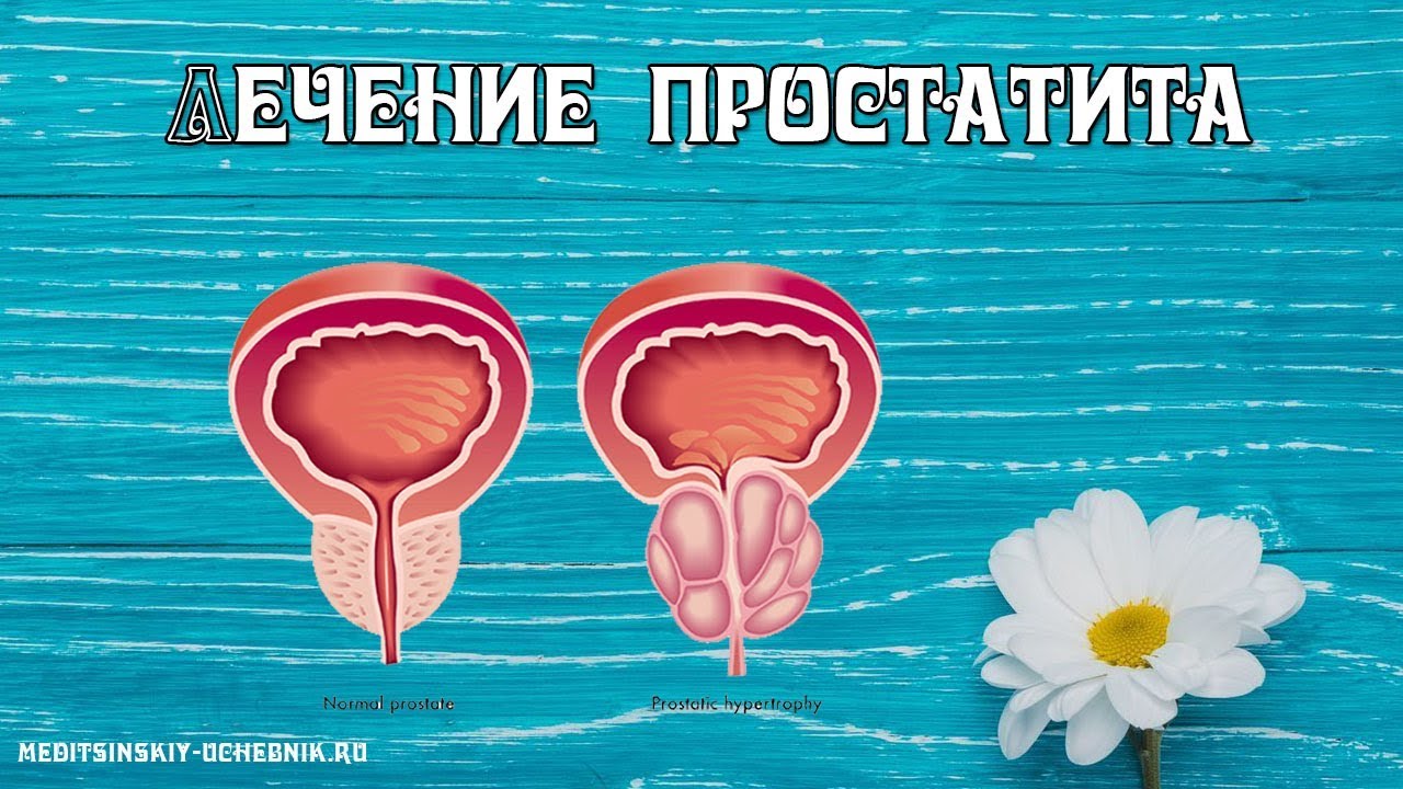 Домашний домашний лечение простаты. Рисунки проведения простатита. Лечение простатита в домашних условиях народными средствами. Лечение бактериального простатита у мужчин народными средствами. Массаж простаты дома мужу как правильно сделать.