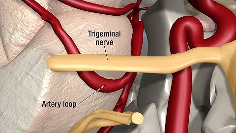 Treatment for Trigeminal Neuralgia: UCSF Neurosurgery