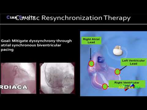 Scompenso Cardiaco: Terapia di Re-Sincornizzazione Cardiaca - RELAZIONE del Dott. Nicola CAPUTO